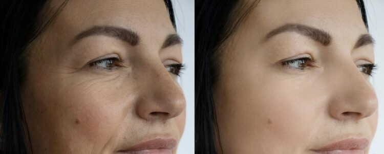 venus-viva-before-after-wrinkle-removal-750x301